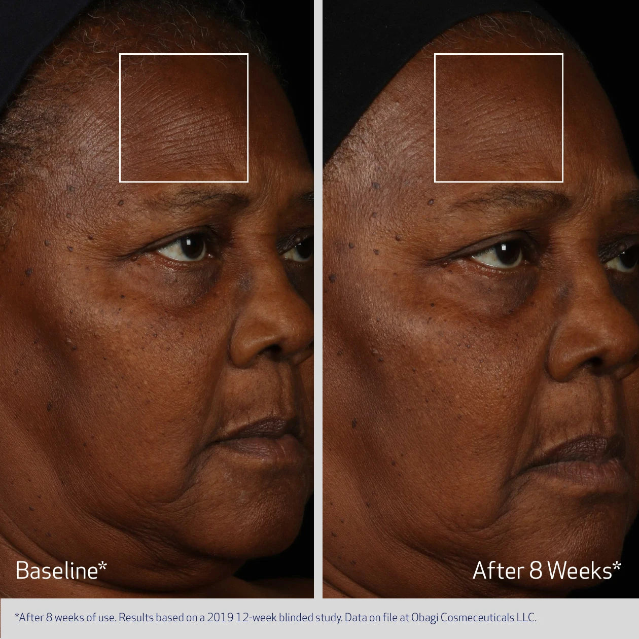 ELASTIDERM FACIAL SERUM BEFORE AND AFTERM8 WEEKS | VISIBLE IMPROVEMENT IN SKIN LAXITY AND FINE LINES | PARTICIPANT 1
