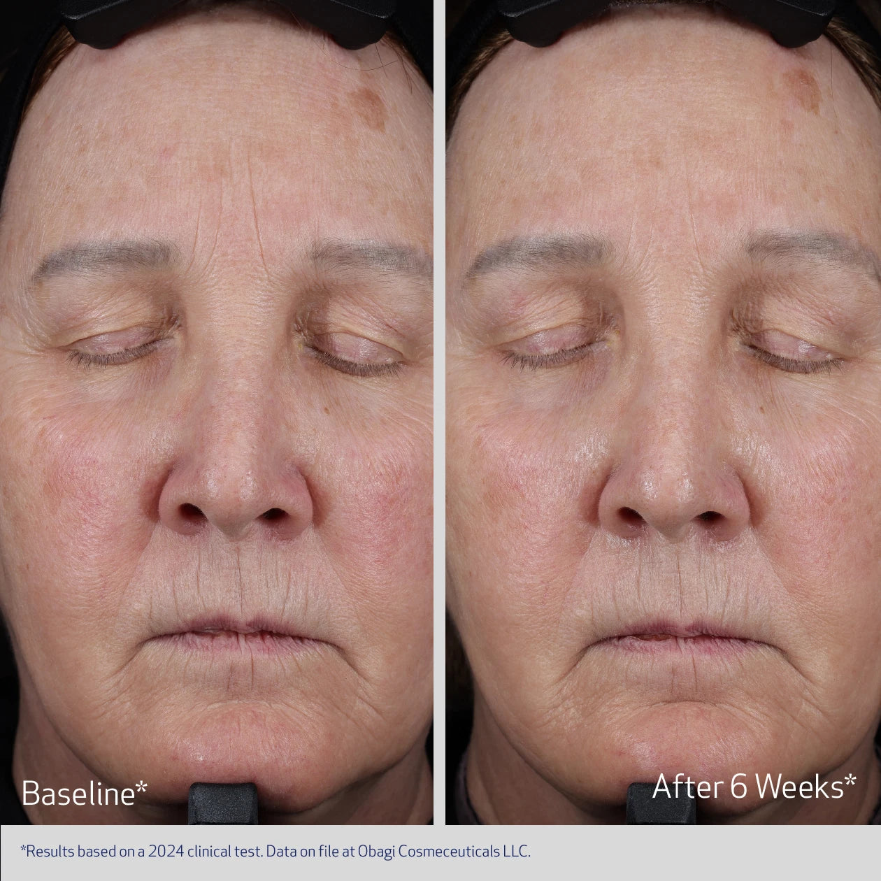 ELASTIDERM LIFT UP & SCULPT FACIAL MOISTURIZER BEFORE AND AFTER 6 WEEKS | VISIBLE IMPROVEMENT IN FOREHEAD LINES AND SAGGING SKIN | PARTICIPANT 1